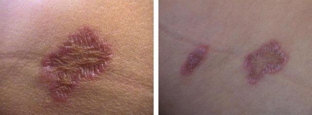 LICHEN - Lichen planus LICHEN - Lichen planus