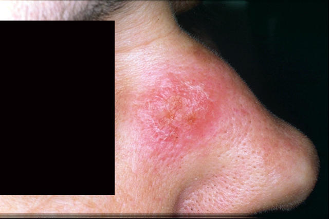 PARASITOSES, BITES - Cutaneous leishmaniasis