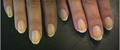 NAIL DISEASES - Yellow nails from staining