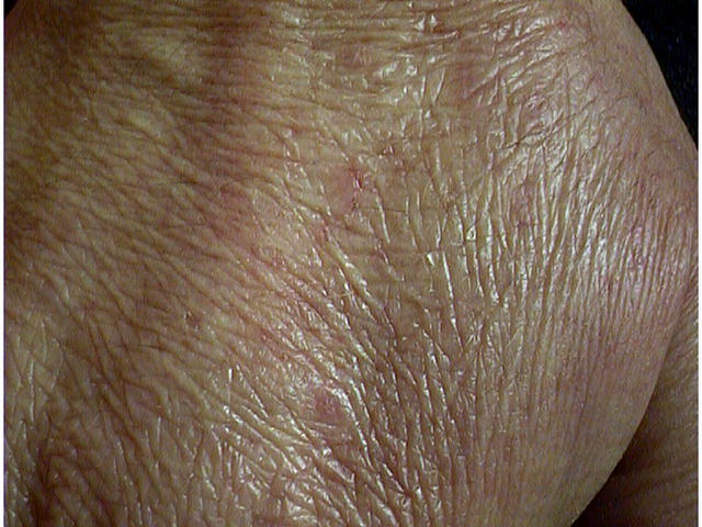 DRUG ERUPTIONS - Skin atrophy from Clobetasol propionate cream