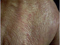 DRUG ERUPTIONS - Skin atrophy from Clobetasol propionate cream