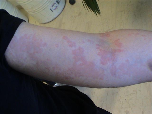 URTICARIA - Urticaria