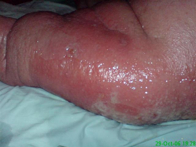 BACTERIAL INFECTIONS - Erysipelas BACTERIAL INFECTIONS - Erysipelas
