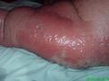 BACTERIAL INFECTIONS - Erysipelas