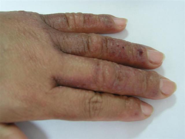 DERMATITIS - EKZEMA - Dermatitis from fig-tree