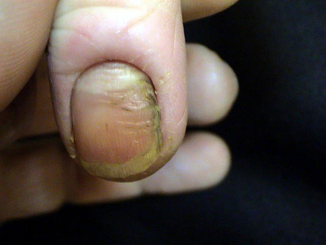 NAIL DISEASES - Onychomycosis due to Candida albicans infection NAIL DISEASES - Onychomycosis due to Candida albicans infection