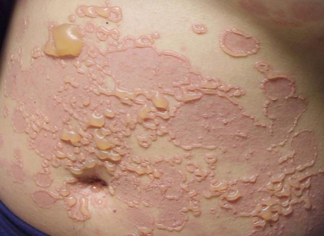BULLOUS DISEASES - Linear IgA Dermatosis