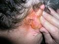BACTERIAL INFECTIONS - Epidermal Cysts of the auricular fold