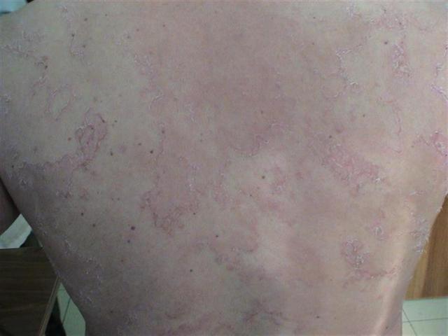 GENODERMATOSES - Netherton syndrome GENODERMATOSES - Netherton syndrome