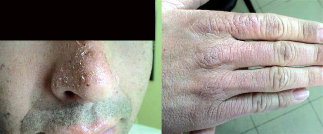 METABOLIC DISEASE, NUTRITION - Erythropoietic porphyria METABOLIC DISEASE, NUTRITION - Erythropoietic porphyria