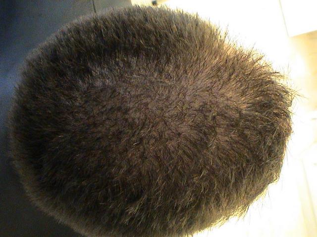 HAIR DISEASES - Androgenetic alopecia