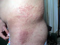 DERMATITIS - EKZEMA - Allergic Contact Dermatitis