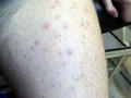 BACTERIAL INFECTIONS - Folliculitis