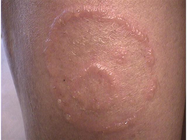 SUPERFICIAL FUNGAL INFECTIONS - Tinea corporis due to trichophyton