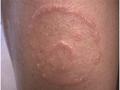 SUPERFICIAL FUNGAL INFECTIONS - Tinea corporis due to trichophyton