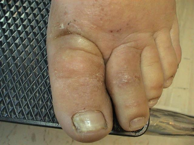 NAIL DISEASES - Onychomycosis