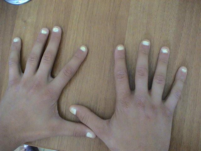 NAIL DISEASES - Leukonychia, congenital