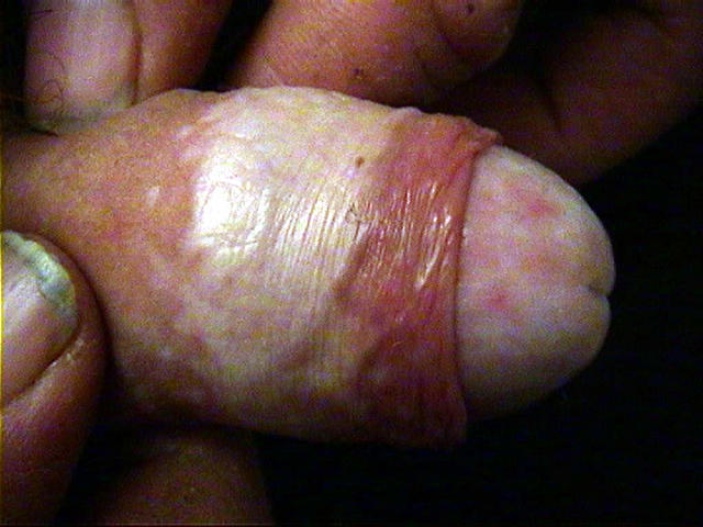 LICHEN - Lichen sclerosus et atrophicus of the penis