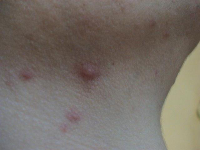 VIRAL INFECTIONS - SmallPox VIRAL INFECTIONS - SmallPox