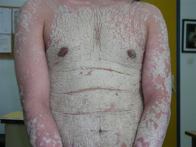 PSORIASIS - Plaque psoriasis