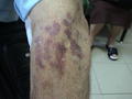 DRUG ERUPTIONS - Ecchymoses due to topical corticosteroids