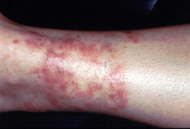 SUPERFICIAL FUNGAL INFECTIONS - Tinea Incognita