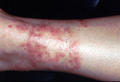 SUPERFICIAL FUNGAL INFECTIONS - Tinea Incognita