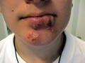 VIRAL INFECTIONS - Herpes Simplex