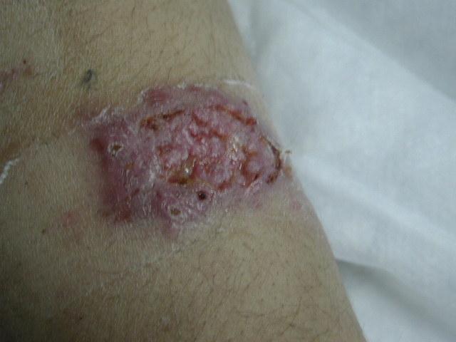 PARASITOSES, BITES - Cutaneous leishmaniasis