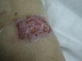 PARASITOSES, BITES - Cutaneous leishmaniasis