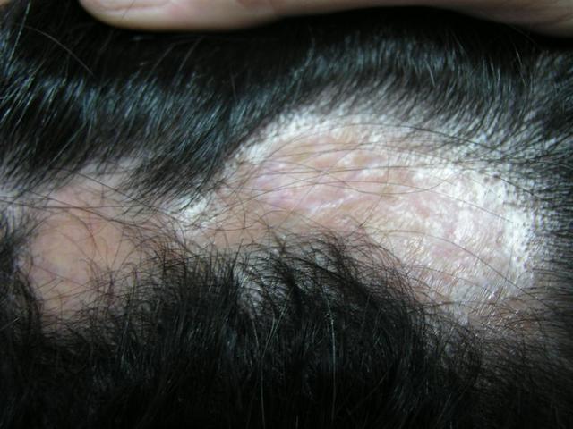 Cicatricial Alopecia on Hair Diseases   Alopecia Cicatricial Picture   Hellenic Dermatological