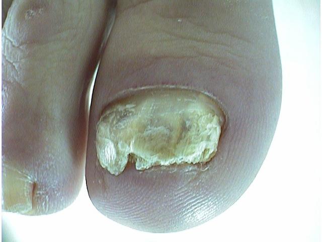 NAIL DISEASES - Onychomycosis NAIL DISEASES - Onychomycosis