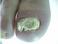 NAIL DISEASES - Onychomycosis