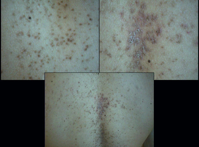 KERATINISATION DISORDERS - Darier disease KERATINISATION DISORDERS - Darier disease