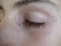 DERMATITIS - EKZEMA - Dermatitis of the eyelids