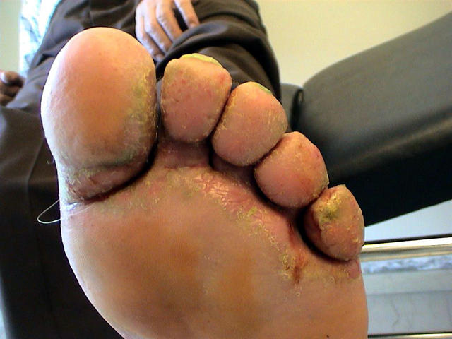 SUPERFICIAL FUNGAL INFECTIONS - Tinea infection SUPERFICIAL FUNGAL INFECTIONS - Tinea infection