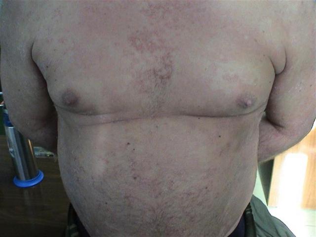 GENODERMATOSES - Netherton syndrome