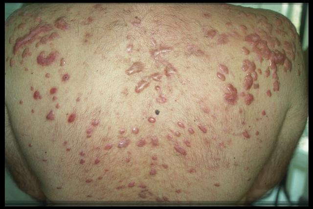 SOFT TISSUE TUMORS - Cheloids SOFT TISSUE TUMORS - Cheloids