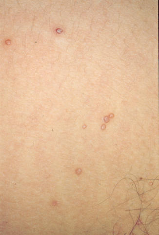 VIRAL INFECTIONS - Mollescum contagiosum