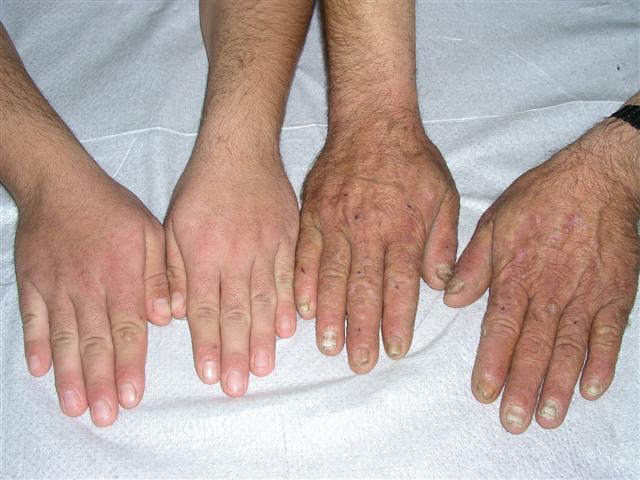 GENODERMATOSES - Acrokeratosis verruciformis of Hopf