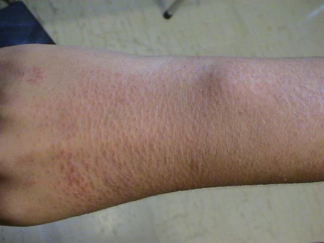 DRUG ERUPTIONS - Retinoid dermatitis DRUG ERUPTIONS - Retinoid dermatitis