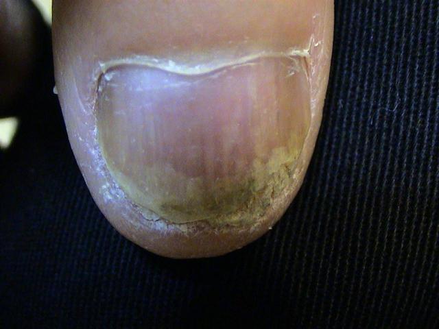 NAIL DISEASES - Onychomycosis due to Tr. rubrum infection