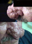 DISEASES OF THE SEBACEOUS GLANDS - Rhinophyma