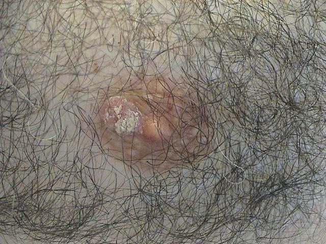 PSORIASIS - Psoriasis of the nipple