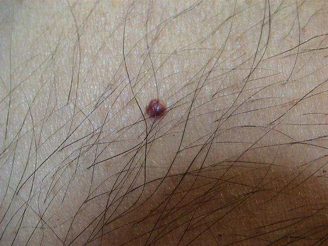DISEASE OF THE BLOOD AND THE VESSELS – PURPURAS - Campbell de Morgan spots DISEASE OF THE BLOOD AND THE VESSELS – PURPURAS - Campbell de Morgan spots
