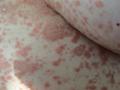 VARIOUS or of UNKNOWN ETIOLOGY DISEASES - Pityriasis rosea