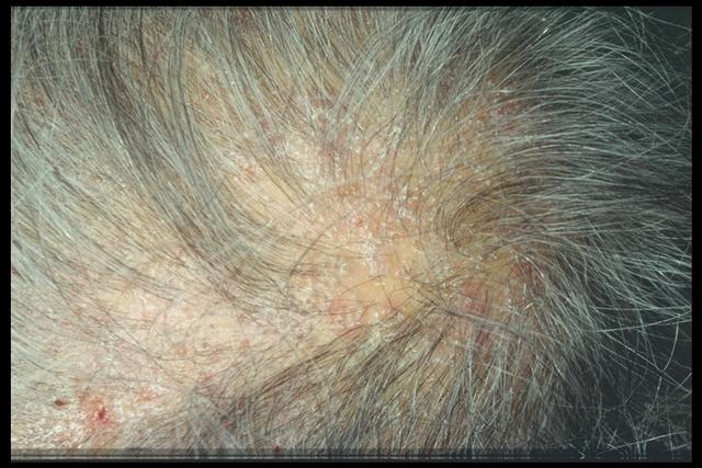 SUPERFICIAL FUNGAL INFECTIONS - Tinea capitis in an adult