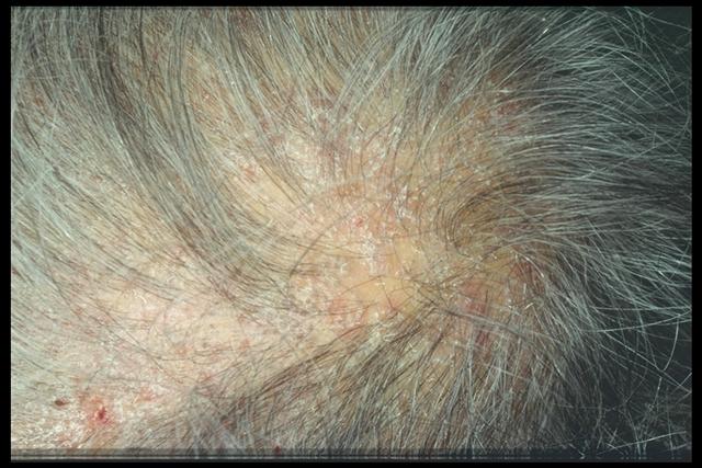 SUPERFICIAL FUNGAL INFECTIONS - Tinea capitis in an adult SUPERFICIAL FUNGAL INFECTIONS - Tinea capitis in an adult
