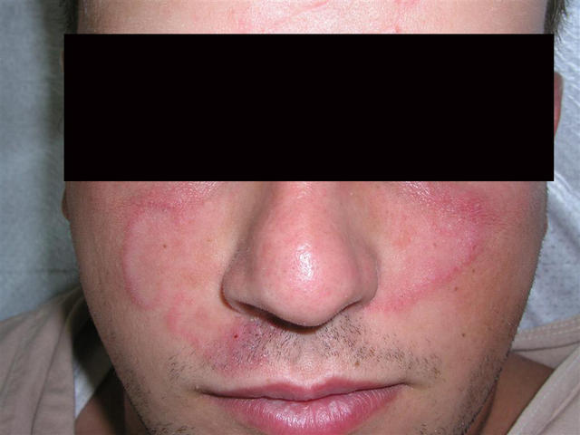 SUPERFICIAL FUNGAL INFECTIONS - Tinea faciale SUPERFICIAL FUNGAL INFECTIONS - Tinea faciale