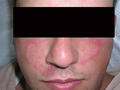 SUPERFICIAL FUNGAL INFECTIONS - Tinea faciale